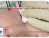 Rejuvenare cu laser a pleoapelor in Moldova (Chisinau)! Blefaroplastie cu laser: Chirurgia laser estetica a pleoapelor