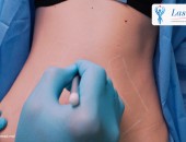 Tehnologie 3D HIFU (High Intensity Focused Ultrasound) pentru Remodelare Corporala in (Chisinau) Moldova  Lipoliza cu tehnologia HIFU!
